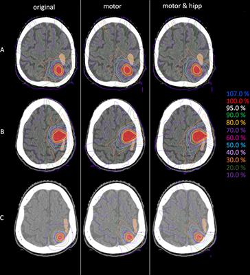 Optimizing Adjuvant Stereotactic Radiotherapy of Motor-Eloquent Brain Metastases: Sparing the nTMS-Defined Motor Cortex and the Hippocampus